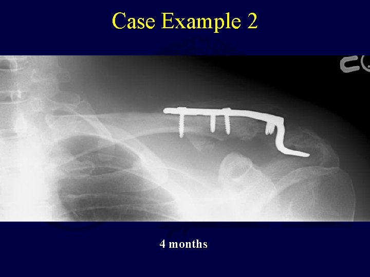 Case Example 2 Sutures passed into this This fragment likely has CC ligament attached;