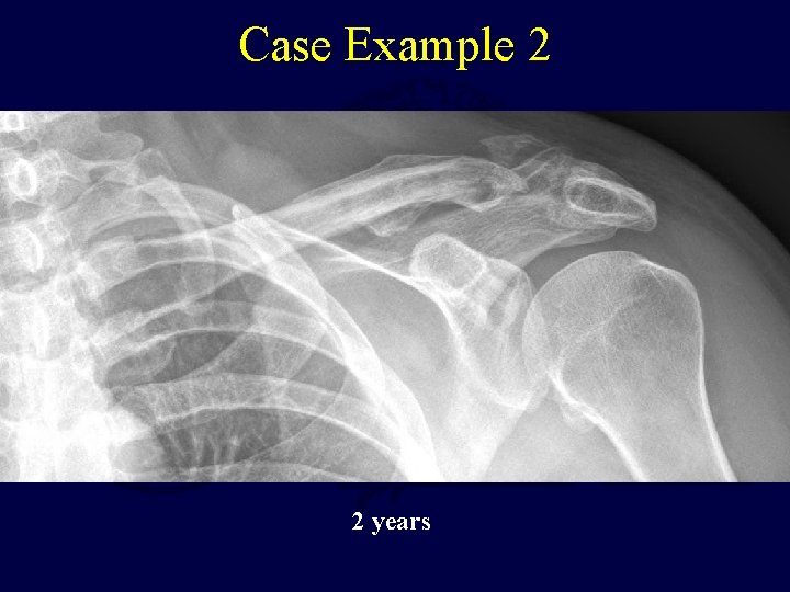 Case Example 2 Sutures passed into this This fragment likely has CC ligament attached;