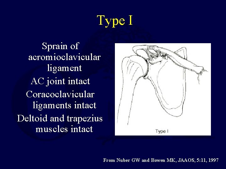 Type I Sprain of acromioclavicular ligament AC joint intact Coracoclavicular ligaments intact Deltoid and