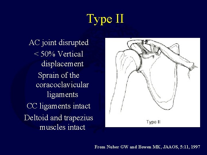 Type II AC joint disrupted < 50% Vertical displacement Sprain of the coracoclavicular ligaments