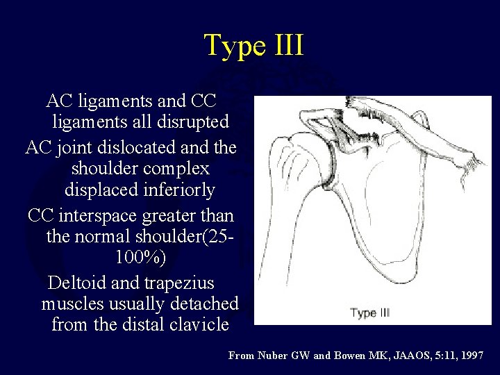 Type III AC ligaments and CC ligaments all disrupted AC joint dislocated and the