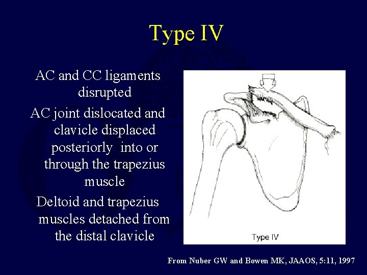 Type IV AC and CC ligaments disrupted AC joint dislocated and clavicle displaced posteriorly