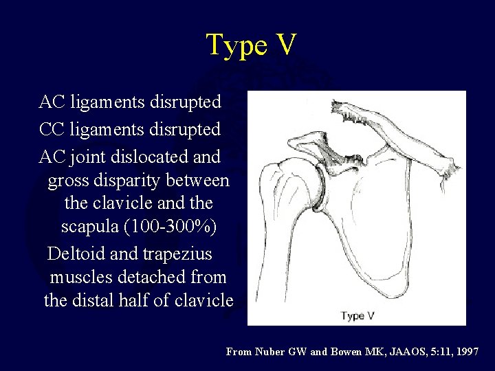 Type V AC ligaments disrupted CC ligaments disrupted AC joint dislocated and gross disparity