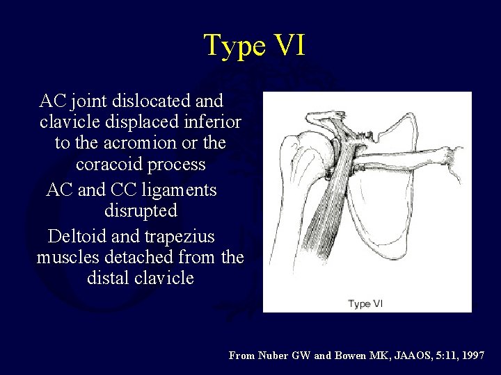 Type VI AC joint dislocated and clavicle displaced inferior to the acromion or the