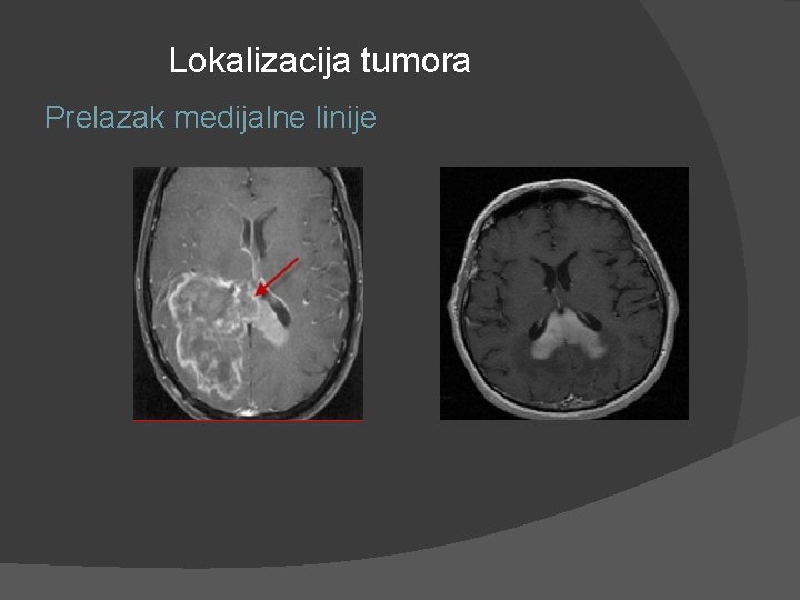 Lokalizacija tumora Prelazak medijalne linije Lokalizacija tumora Prelazak medijalne linije