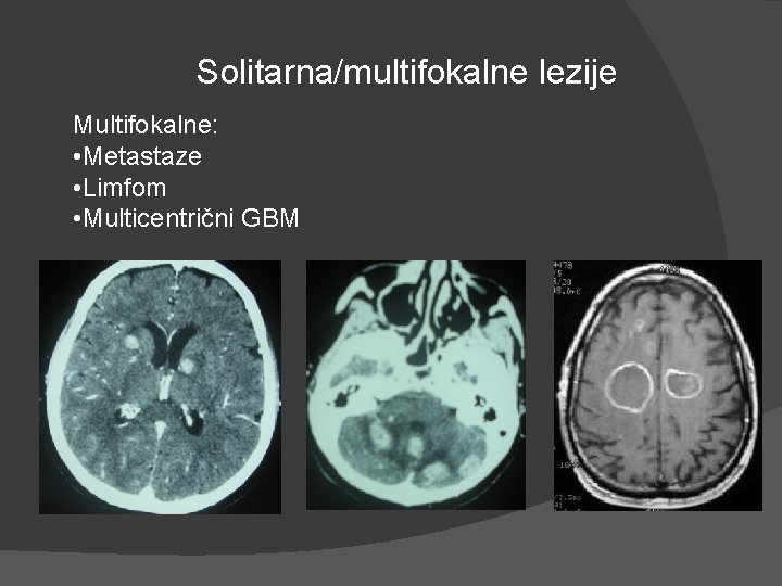 Solitarna/multifokalne lezije Multifokalne: • Metastaze • Limfom • Multicentrični GBM Solitarna/multifokalne lezije Multifokalne: • Metastaze • Limfom • Multicentrični GBM