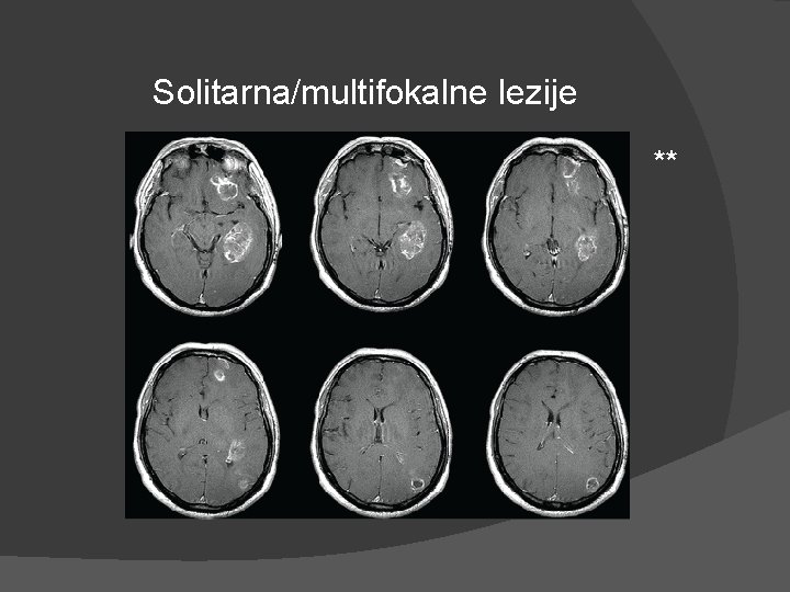 Solitarna/multifokalne lezije ** Solitarna/multifokalne lezije **