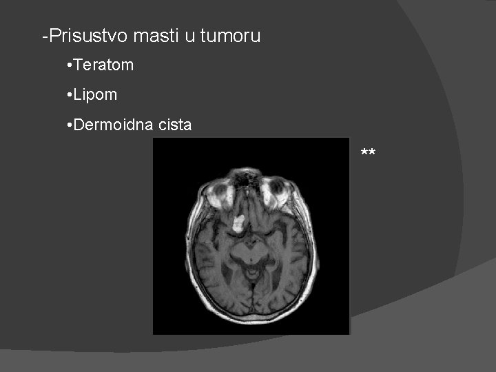 -Prisustvo masti u tumoru • Teratom • Lipom • Dermoidna cista ** -Prisustvo masti u tumoru • Teratom • Lipom • Dermoidna cista **
