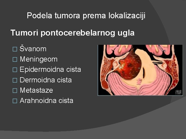 Podela tumora prema lokalizaciji Tumori pontocerebelarnog ugla Švanom � Meningeom � Epidermoidna cista � Podela tumora prema lokalizaciji Tumori pontocerebelarnog ugla Švanom � Meningeom � Epidermoidna cista �