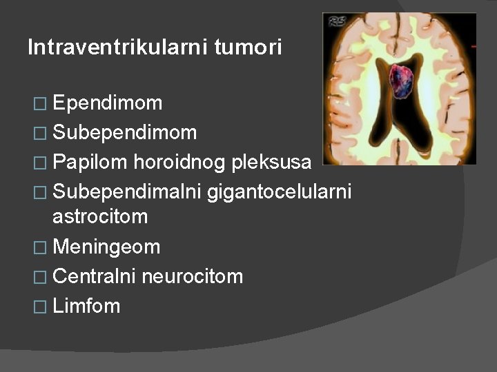 Intraventrikularni tumori � Ependimom � Subependimom � Papilom horoidnog pleksusa � Subependimalni gigantocelularni astrocitom Intraventrikularni tumori � Ependimom � Subependimom � Papilom horoidnog pleksusa � Subependimalni gigantocelularni astrocitom
