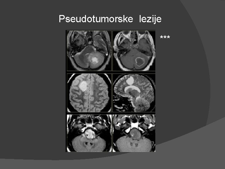 Pseudotumorske lezije *** Pseudotumorske lezije ***