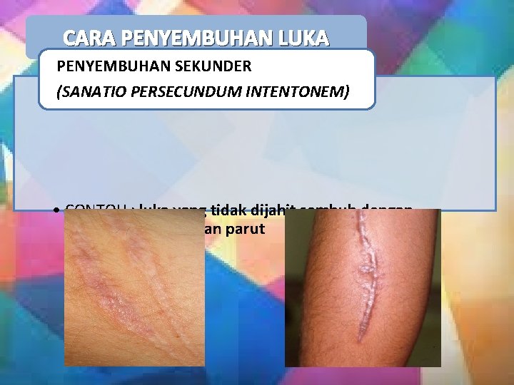 CARA PENYEMBUHAN LUKA PENYEMBUHAN SEKUNDER (SANATIO PERSECUNDUM INTENTONEM) • CONTOH : luka yang tidak