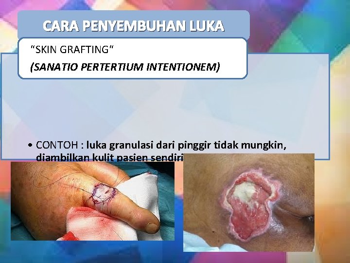 CARA PENYEMBUHAN LUKA “SKIN GRAFTING“ (SANATIO PERTERTIUM INTENTIONEM) • CONTOH : luka granulasi dari