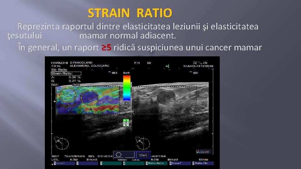 STRAIN RATIO Reprezinta raportul dintre elasticitatea leziunii şi elasticitatea ţesutului mamar normal adiacent. În