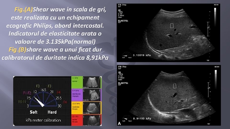 Fig. (A)Shear wave in scala de gri, este realizata cu un echipament ecografic Philips,