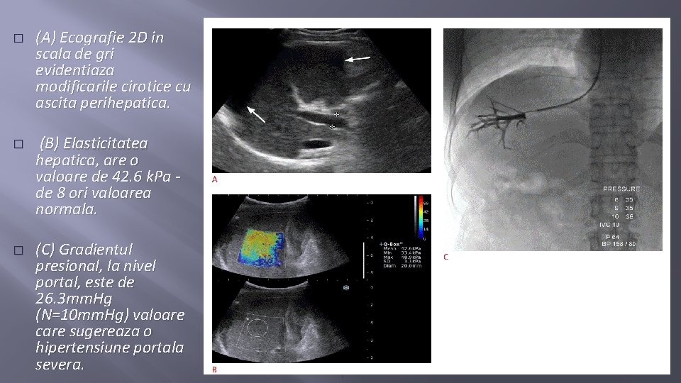 � � � (A) Ecografie 2 D in scala de gri evidentiaza modificarile cirotice