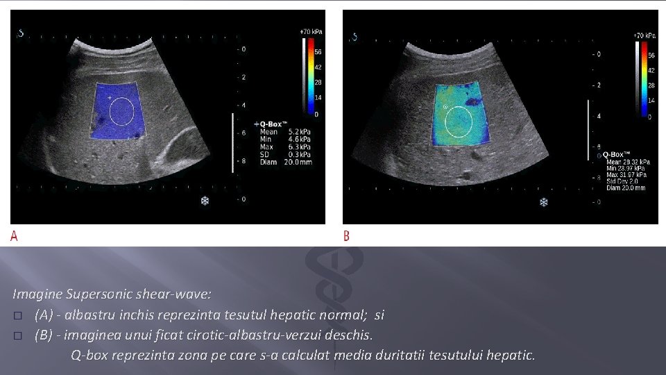 Imagine Supersonic shear-wave: � (A) - albastru inchis reprezinta tesutul hepatic normal; si �