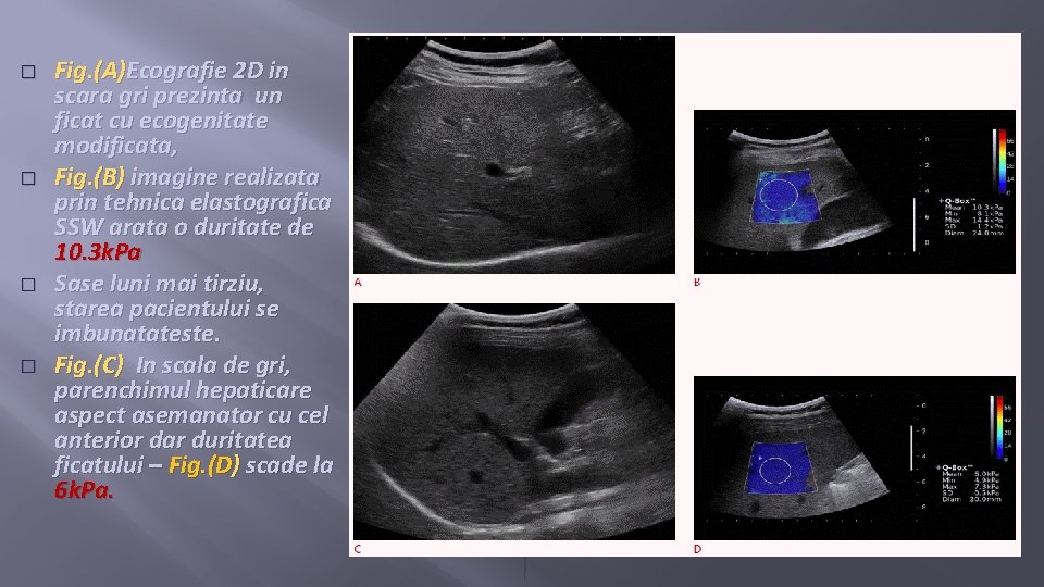 � � Fig. (A)Ecografie 2 D in scara gri prezinta un ficat cu ecogenitate