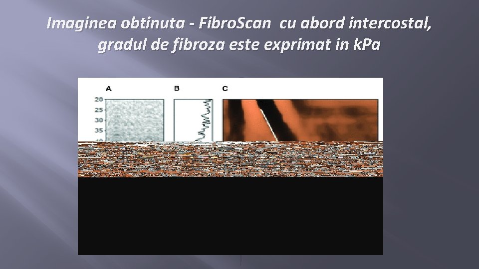 Imaginea obtinuta - Fibro. Scan cu abord intercostal, gradul de fibroza este exprimat in