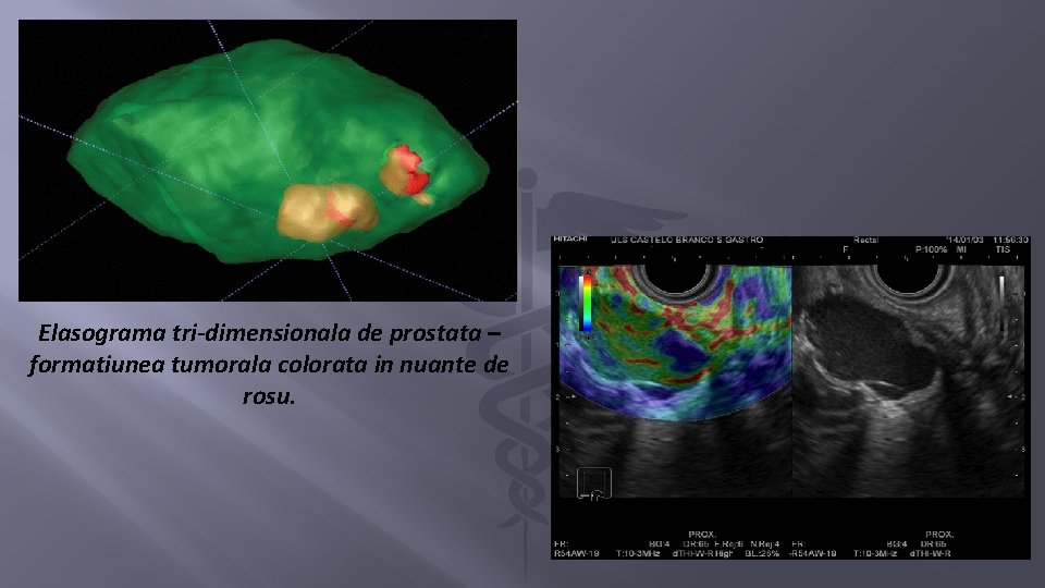 Elasograma tri-dimensionala de prostata – formatiunea tumorala colorata in nuante de rosu. 