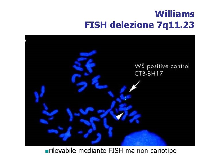 Williams FISH delezione 7 q 11. 23 nrilevabile mediante FISH ma non cariotipo 