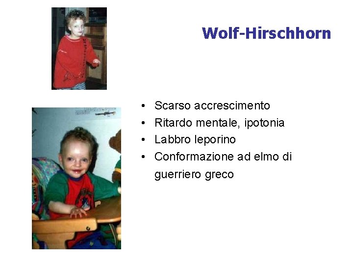 Wolf-Hirschhorn • • Scarso accrescimento Ritardo mentale, ipotonia Labbro leporino Conformazione ad elmo di