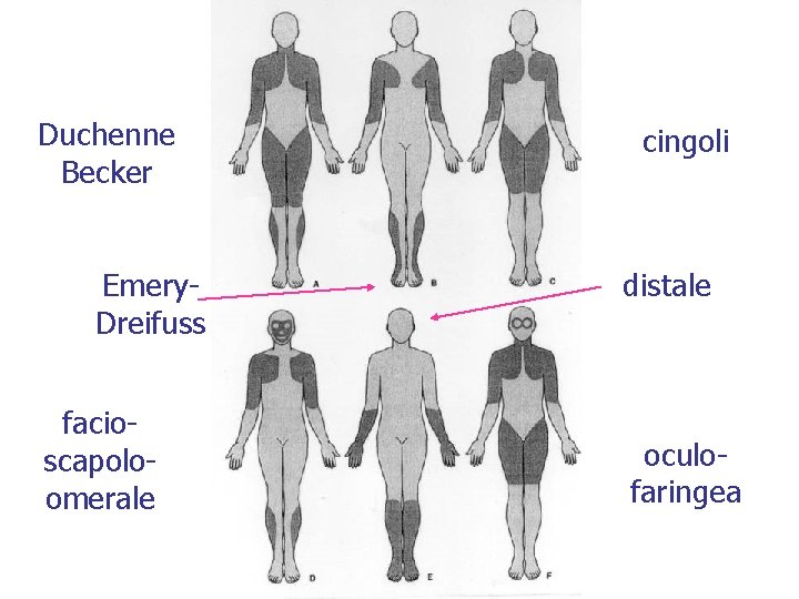 Duchenne Becker Emery. Dreifuss facioscapoloomerale cingoli distale oculofaringea 