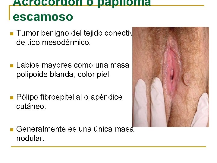 papiloma fibroepitelial escamoso