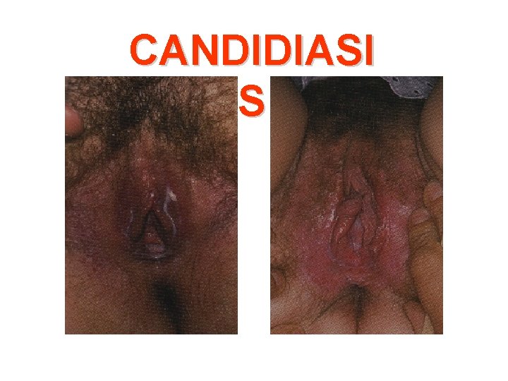 CANDIDIASI S 