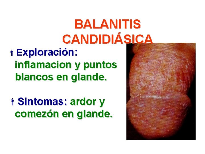 BALANITIS CANDIDIÁSICA Exploración: inflamacion y puntos blancos en glande. Sintomas: ardor y comezón en