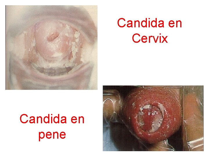 Candida en Cervix Candida en pene 