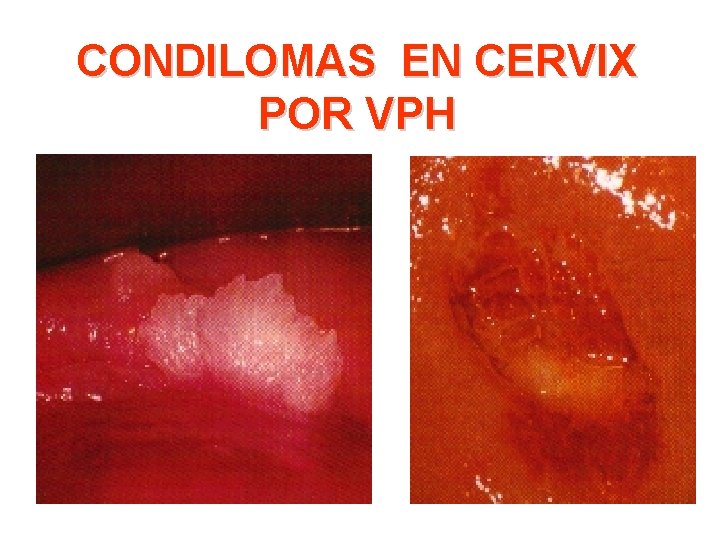 CONDILOMAS EN CERVIX POR VPH 