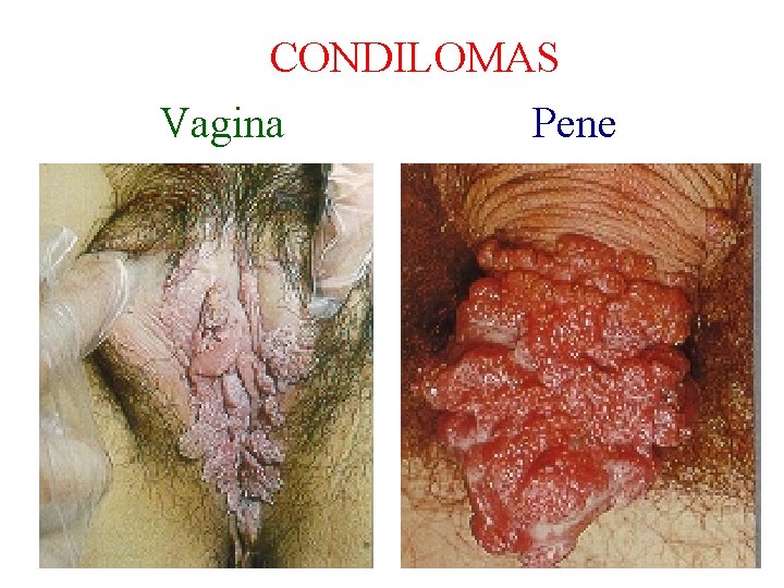 CONDILOMAS Vagina Pene 