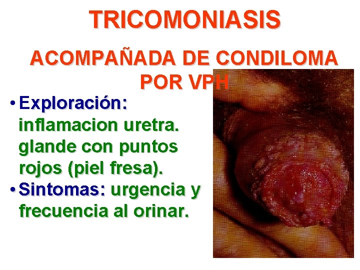 TRICOMONIASIS ACOMPAÑADA DE CONDILOMA POR VPH • Exploración: inflamacion uretra. glande con puntos rojos