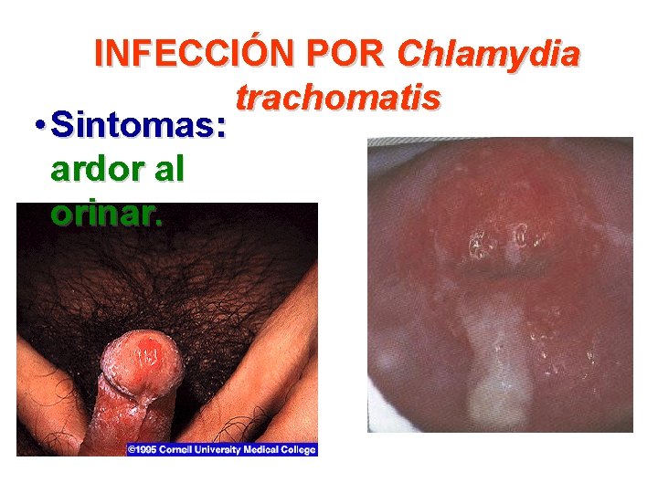 INFECCIÓN POR Chlamydia trachomatis • Sintomas: ardor al orinar. 