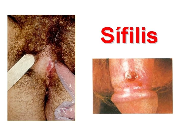 Sífilis 