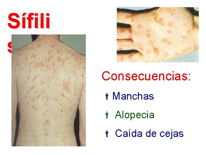 Sífili s Consecuencias: Manchas Alopecia Caída de cejas 