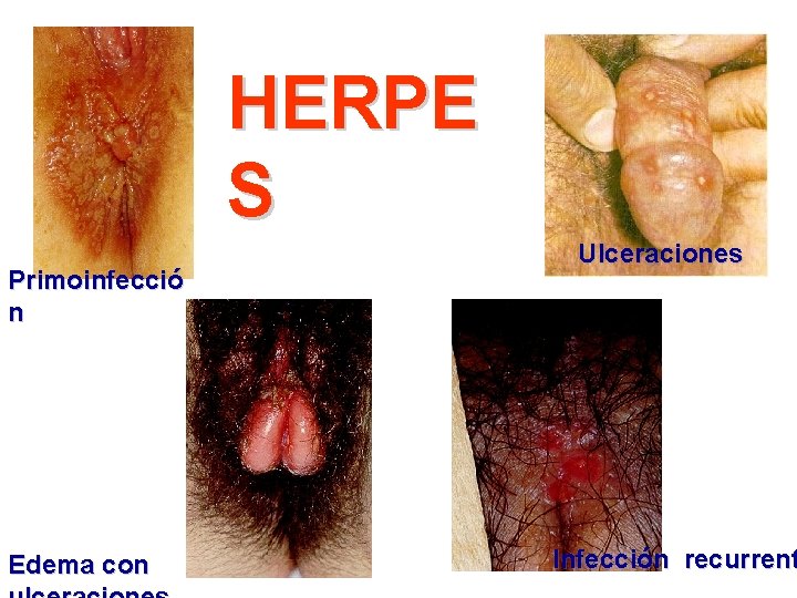 HERPE S Primoinfecció n Edema con Ulceraciones Infección recurrent 