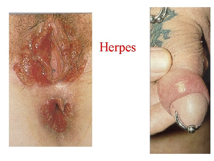 Herpes 