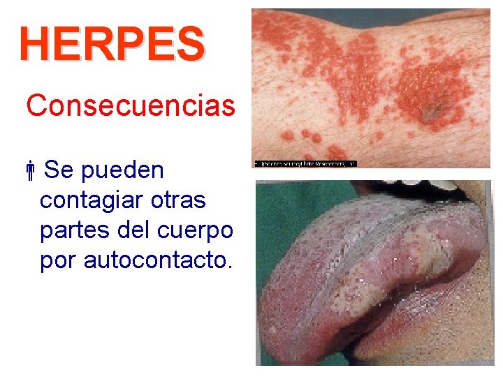HERPES Consecuencias Se pueden contagiar otras partes del cuerpo por autocontacto. 