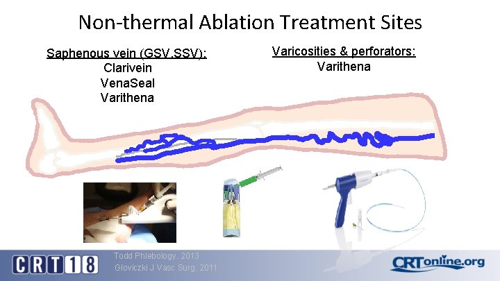 Non-thermal Ablation Treatment Sites Saphenous vein (GSV, SSV): Clarivein Vena. Seal Varithena Todd Phlebology.