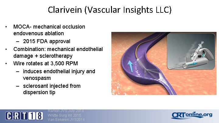 Clarivein (Vascular Insights LLC) • • • MOCA- mechanical occlusion endovenous ablation – 2015