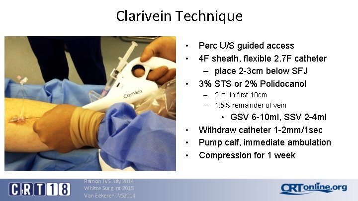 Clarivein Technique • • • Perc U/S guided access 4 F sheath, flexible 2.