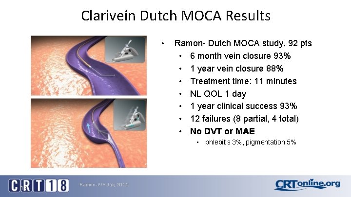 Clarivein Dutch MOCA Results • Ramon- Dutch MOCA study, 92 pts • 6 month