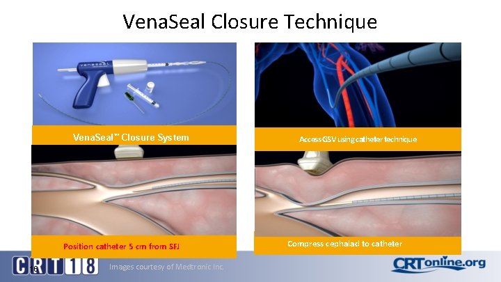 Vena. Seal Closure Technique Vena. Seal™ Closure System Position catheter 5 cm from SFJ