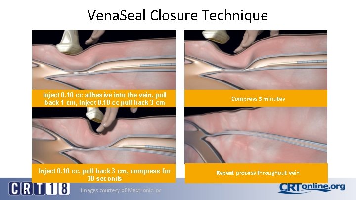 Vena. Seal Closure Technique 17 Inject 0. 10 cc adhesive into the vein, pull