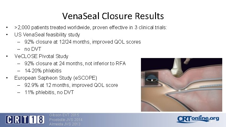 Vena. Seal Closure Results • • >2, 000 patients treated worldwide, proven effective in