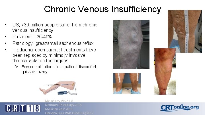 Chronic Venous Insufficiency • • US, >30 million people suffer from chronic venous insufficiency