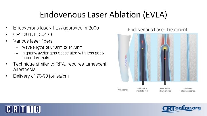 Endovenous Laser Ablation (EVLA) • • • Endovenous laser- FDA approved in 2000 CPT