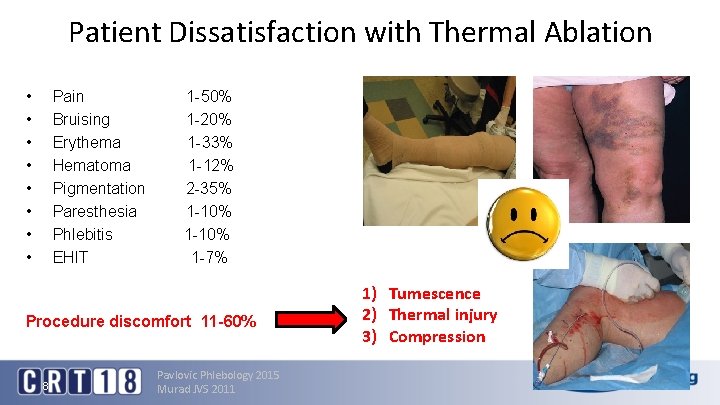 Patient Dissatisfaction with Thermal Ablation • • Pain Bruising Erythema Hematoma Pigmentation Paresthesia Phlebitis